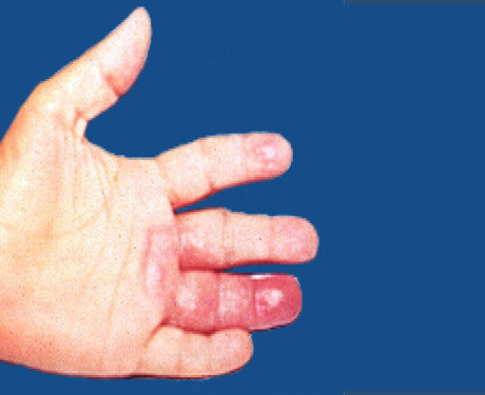 Mão de indivíduo infectado com lepra limítrofe/borderline – Foto: Domínio Público via Wimedia Commons