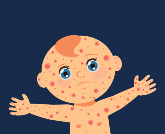 Herpes em bebês: quais os riscos e como evitar?