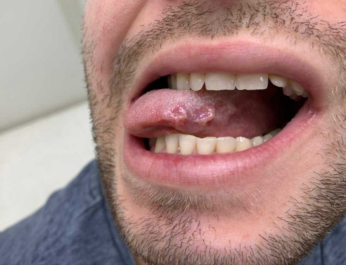 Três lesões ulceradas com bordas emolduradas na língua