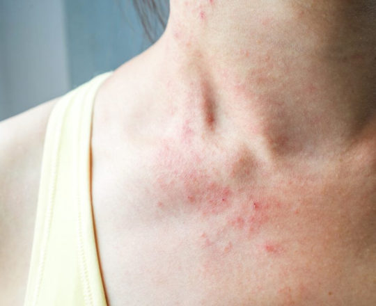 ‘Efeitos da covid’: 21% dos infectados relataram só problemas de pele, diz estudo; lesões não devem ser ignoradas