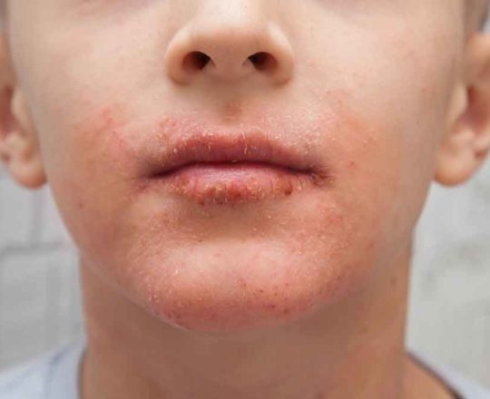 Vários mal-entendidos atrapalham a vida de quem sofre de dermatite atópica