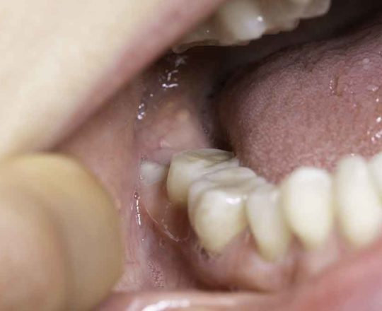 Mancha, ferida e nódulo: câncer de boca dá sinais e pede diagnóstico rápido